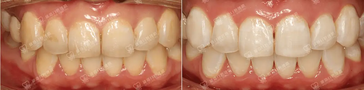 深圳種牙&深圳維港口腔