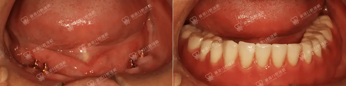 深圳種牙&深圳維港口腔
