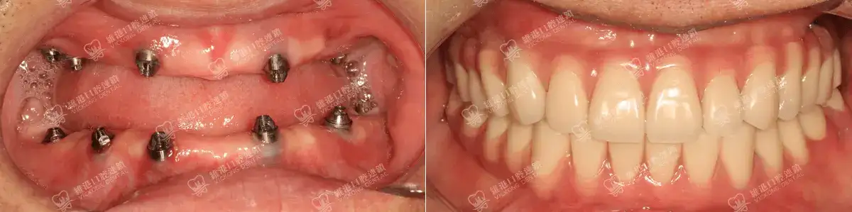 深圳種牙&深圳維港口腔
