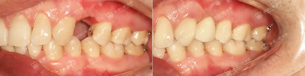 深圳種牙&深圳維港口腔