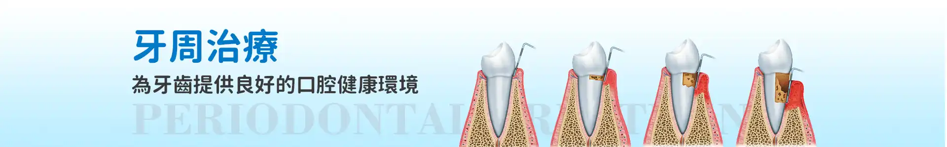 深圳牙周病&牙周治療
